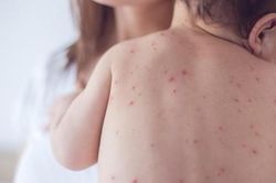 Bộ Y tế khuyến cáo 5 biện pháp phòng chống bệnh Sởi