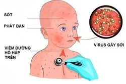 Biện pháp phòng ngừa bệnh sởi cho trẻ