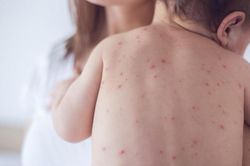 Bộ Y tế: Chủ động đưa trẻ từ 9 tháng đến 2 tuổi tiêm đủ vắc xin sởi