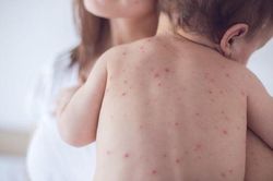 Bộ Y tế ra chỉ đạo mới về bệnh sởi