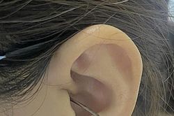 Cô gái thủng màng nhĩ vì bị va trúng khi đang lấy ráy tai
