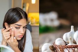 Phương pháp trị mụn bằng tỏi đang 'viral' trên Tóp Tóp có thực sự hiệu quả?