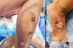 Cảnh báo thói quen tự điều trị tại nhà bằng lá cây, thuốc nam