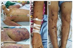 Từ vụ sinh viên Bách Khoa ăn cơm canh thừa: Khuyến cáo về một căn bệnh cực kỳ nguy hiểm, có khả năng lây chéo