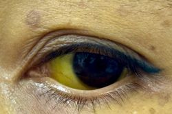 Men gan tăng hơn 11 lần do tự ý điều trị bệnh bằng thuốc nam