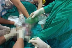 Mổ cứu thai nhi khi sản phụ ngừng tuần hoàn, ngừng hô hấp