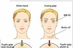 Bệnh cường giáp có ảnh hưởng đến khả năng sinh con không?