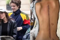Bạn gái hơn 10 tuổi của con trai Beckham tiết lộ vết sẹo phẫu thuật khiến cô 'không thể đứng vững'