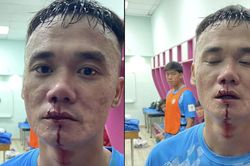 Toàn cảnh vụ cựu tuyển thủ Việt Nam mặt bê bết máu sau vụ ẩu đả với cầu thủ trẻ TPHCM