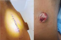 Bị mụn nhọt nên xử lý thế nào tránh biến chứng nguy hiểm?