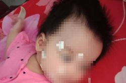 Bé gái hơn 1 tuổi ở Phú Thọ liệt dây thần kinh số 7 ngoại biên, bác sĩ chỉ rõ nguyên nhân rất hay gặp trong mùa lạnh