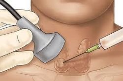 Chọc dò FNA có đau và gây biến chứng không?