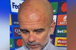 Pep Guardiola lộ gương mặt bầm tím trong buổi họp báo sau trận Man City vs Feyenoord
