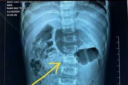 Trẻ gù cột sống thắt lưng, nguyên nhân khiến cha mẹ bất ngờ