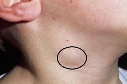 Bệnh lao hạch biểu hiện thế nào, có nguy hiểm không?