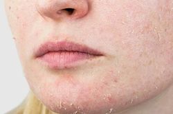 Chăm sóc phục hồi da sau điều trị các tình trạng da