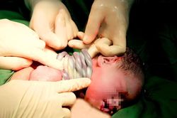 Bé gái chào đời với 9 vòng dây rốn quấn cổ cực hiếm