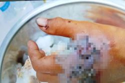 Nhiều trường hợp nhập viện do tự chế pháo nổ