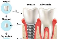 Quá trình trồng răng implant có đau không?