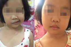 Trẻ liệt mặt, méo miệng, cha mẹ nên làm gì?