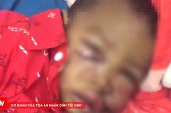 Cháu bé 2 tuổi bị chó hoang tấn công, cắn vào mặt phải nhập viện