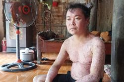 Ông Hà Văn Phượng toàn thân bong tróc được bạn đọc ủng hộ hơn 32 triệu đồng