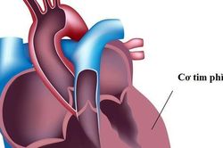 Cơ tim phì đại: Nguyên nhân, biểu hiện, cách điều trị và phòng bệnh