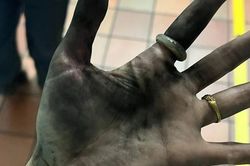Cục sạc dự phòng bất ngờ phát nổ, người phụ nữ hoảng hồn khi nhìn xuống bàn tay mình
