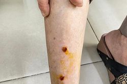 Sai lầm khiến nhiều người mất mạng vì bệnh dại