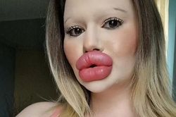 Chi nửa tỷ, cô gái tiêm 30 lần để có 'đôi môi lớn nhất thế giới'