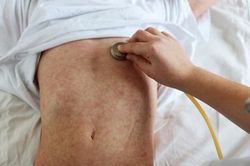 Bệnh sởi gia tăng, chăm sóc đúng cách trẻ mắc sởi tại nhà