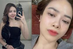 Ca sĩ Dương Hoàng Yến bị liệt dây thần kinh số 7 ngoại biên