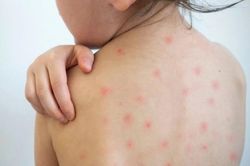 Dịch sởi gia tăng, Hà Nội ghi nhận 1 ca tử vong