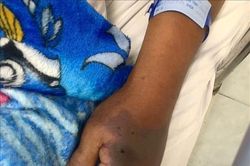 Tiêm 18 lọ huyết thanh cứu cụ ông bị rắn hổ đất cắn