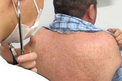 Nhiều người lớn mắc sởi biến chứng nặng