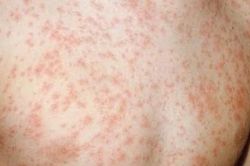 Ghi nhận 2 ca tử vong liên quan đến sởi