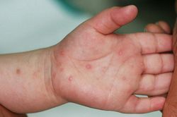 Bệnh tay chân miệng tại TP Hồ Chí Minh đang có dấu hiệu gia tăng trở lại