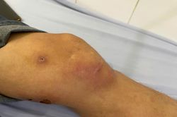 Phát hiện một bệnh nhân nhiễm giun rồng, loại ký sinh trùng hiếm gặp