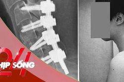 NHỊP SỐNG 24: Thanh niên mắc 'hội chứng rụng đầu' vì dùng điện thoại
