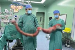 Người đàn ông không đi đại tiện suốt 4 tháng, bác sĩ phẫu thuật lấy ra khối ruột nặng hơn 20kg