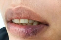 Tưởng khô môi, dị ứng đi khám mắc lupus ban đỏ dạng đĩa