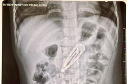 Bé gái 21 tháng tuổi nhập viện gấp với chiếc kẹp tóc trong dạ dày