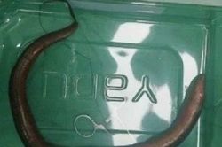 Đau bụng đi khám, bác sĩ sốc nặng khi lấy ra thứ trong bụng người đàn ông