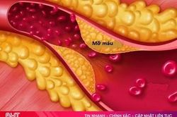 Mỡ máu cao không được chủ quan, kể cả người gầy