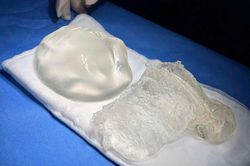 Tháo túi ngực, mê mask thanh quản