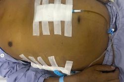 Ung thư gan vì chủ quan với một căn bệnh tưởng nhẹ