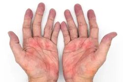 Sưng ở 5 chỗ này - dấu hiệu gan đang 'kêu cứu' vì xơ hóa