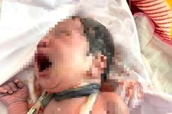 Hy hữu: Bé sơ sinh chào đời với dây rốn quấn 6 vòng quanh cổ