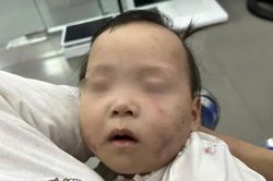 Bắc Ninh: làm rõ vụ bé gái bị bầm tím mặt khi gửi tại nhà trẻ tư thục