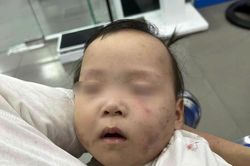 Làm rõ nguyên nhân bé gái bị bầm tím mặt khi gửi ở nhà trẻ Bắc Ninh